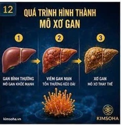 ĐÔNG TRÙNG HẠ THẢO VÀ QUÁ TRÌNH HÌNH THÀNH MÔ XƠ GAN: GÓC NHÌN TỪ Y HỌC HIỆN ĐẠI