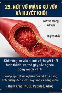 CORDYCEPIN VÀ MẢNG XƠ VỮA KHÔNG ỔN ĐỊNH – NGUY CƠ TIỀM ẨN DẪN ĐẾN NHỒI MÁU CƠ TIM