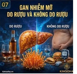 GAN NHIỄM MỠ DO RƯỢU VÀ KHÔNG DO RƯỢU: VAI TRÒ TIỀM NĂNG CỦA ĐÔNG TRÙNG HẠ THẢO
